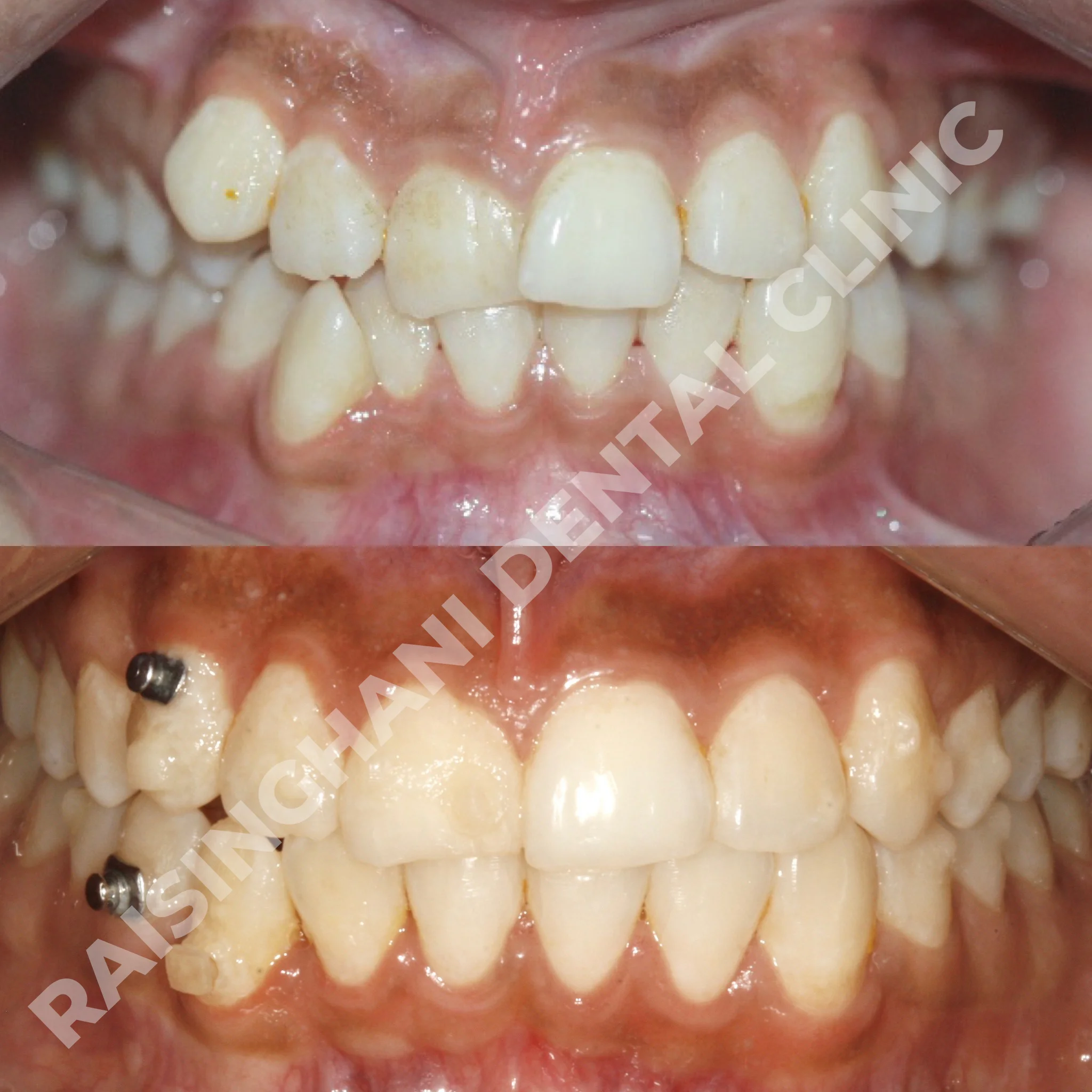 Braces & Aligners