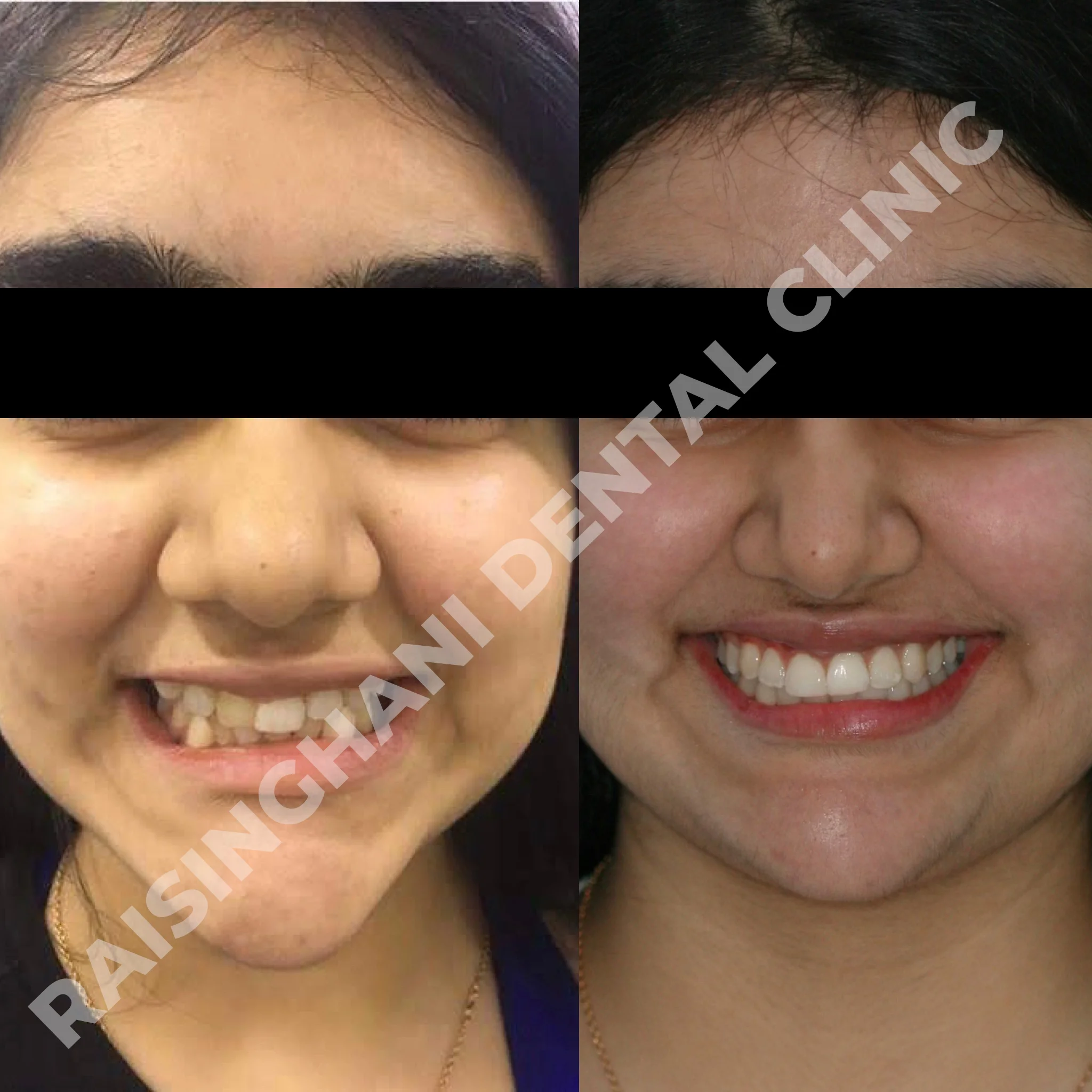 Braces & Aligners