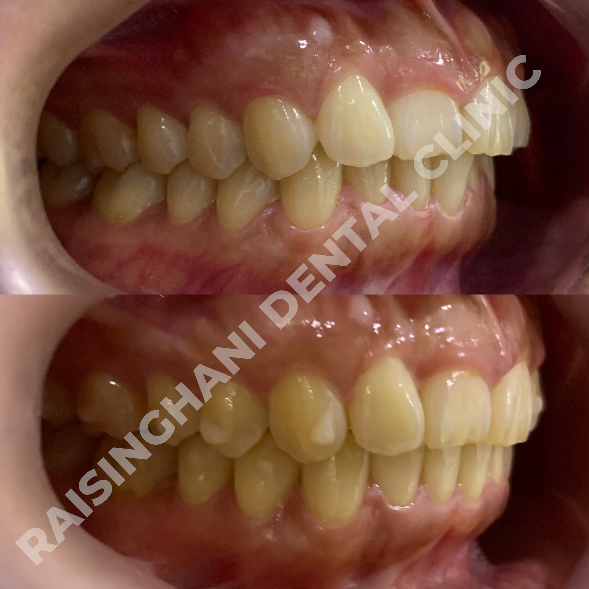 Braces & Aligners