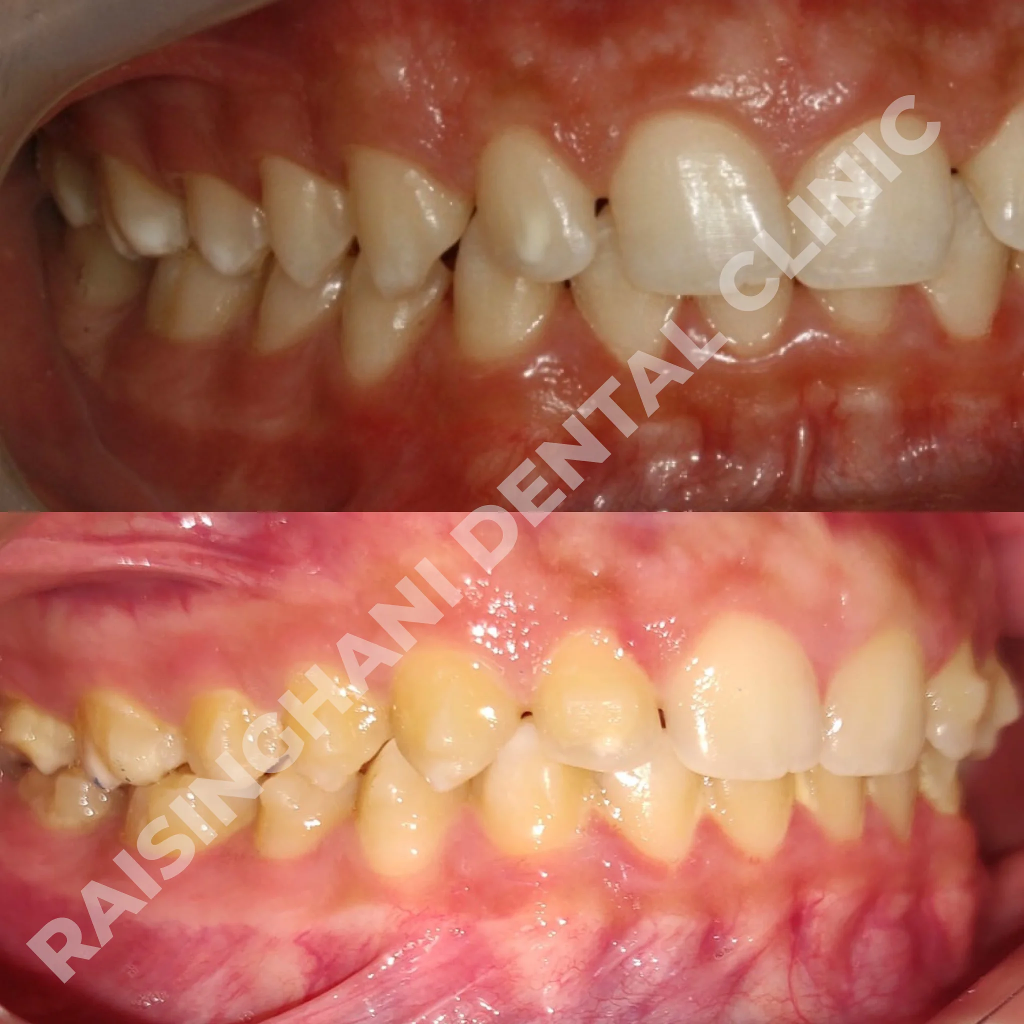 Braces & Aligners