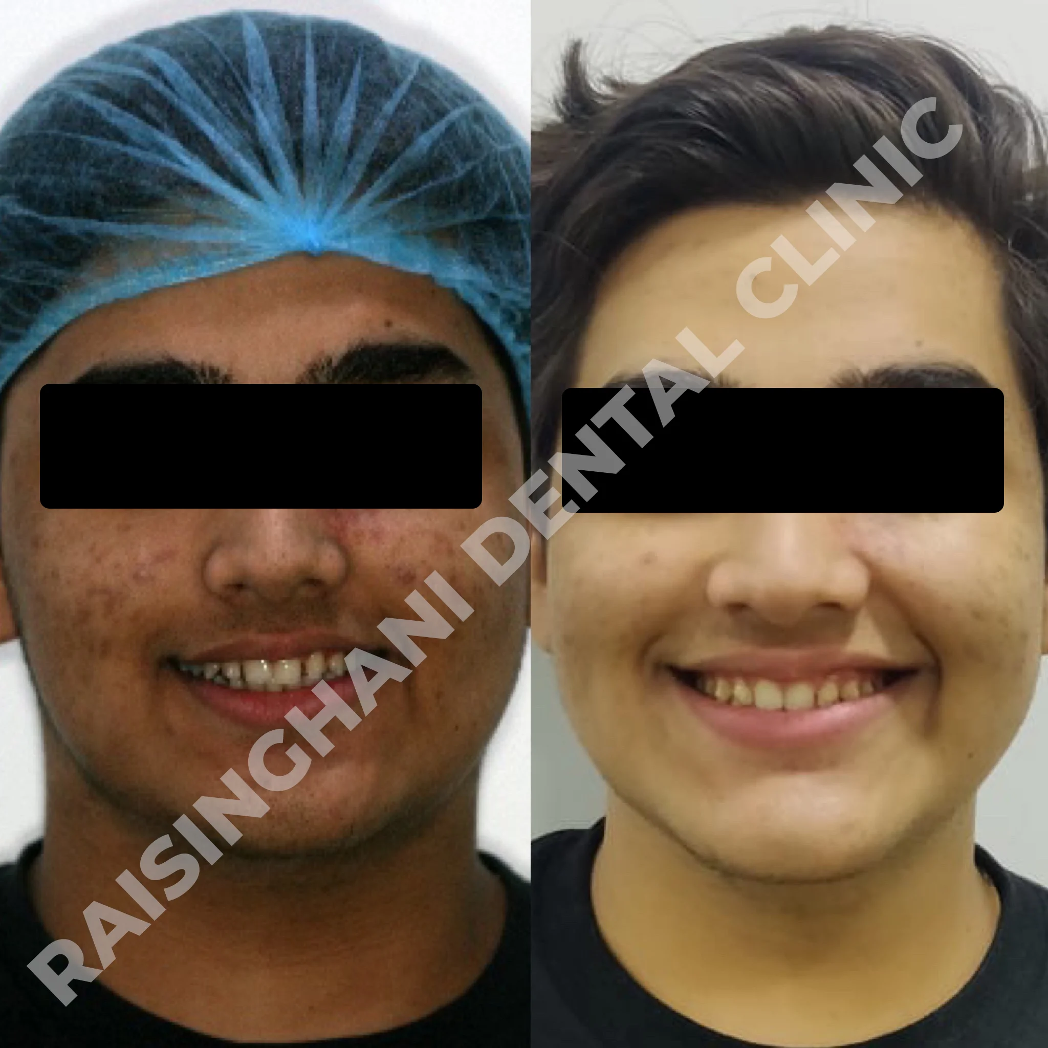 Braces & Aligners