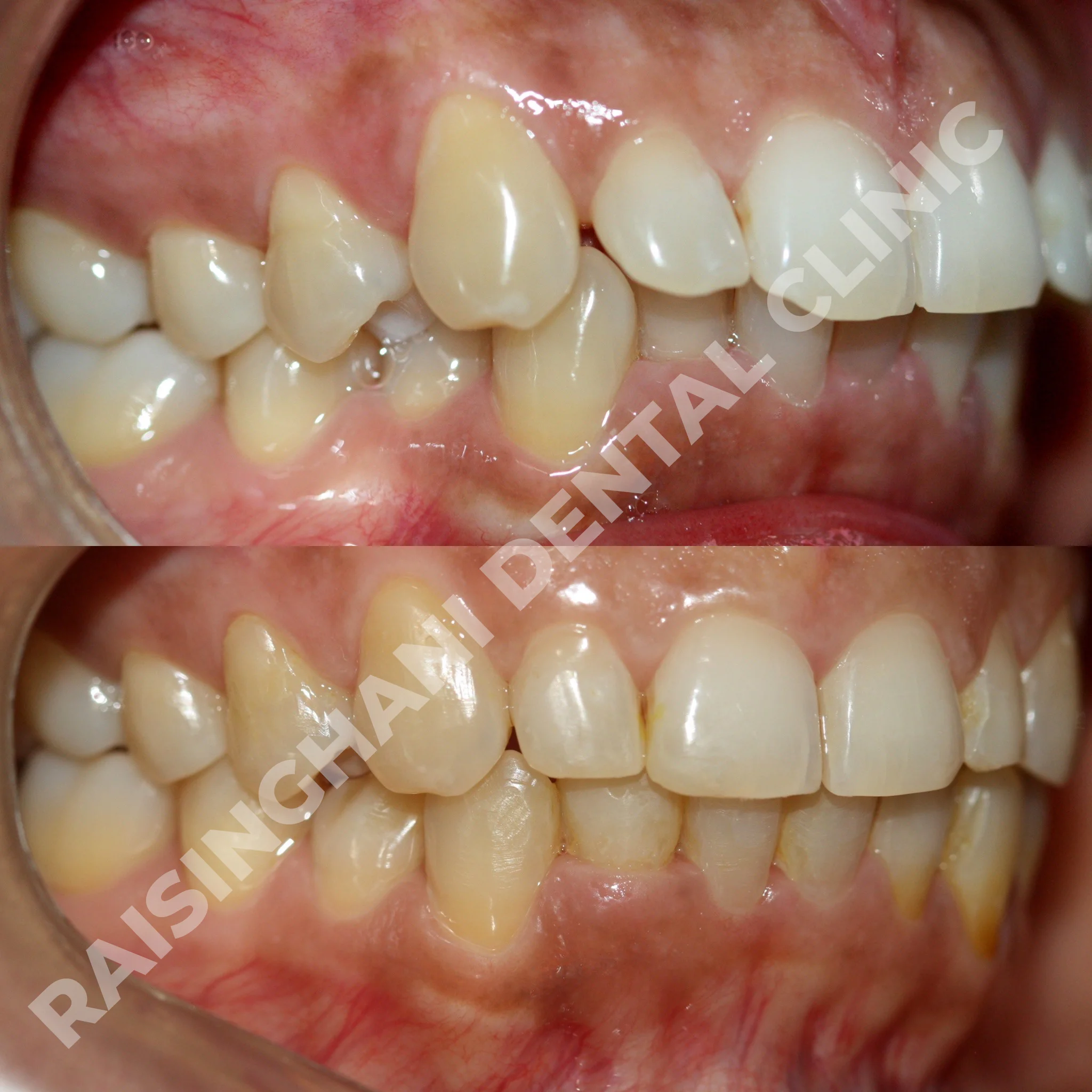 Braces & Aligners