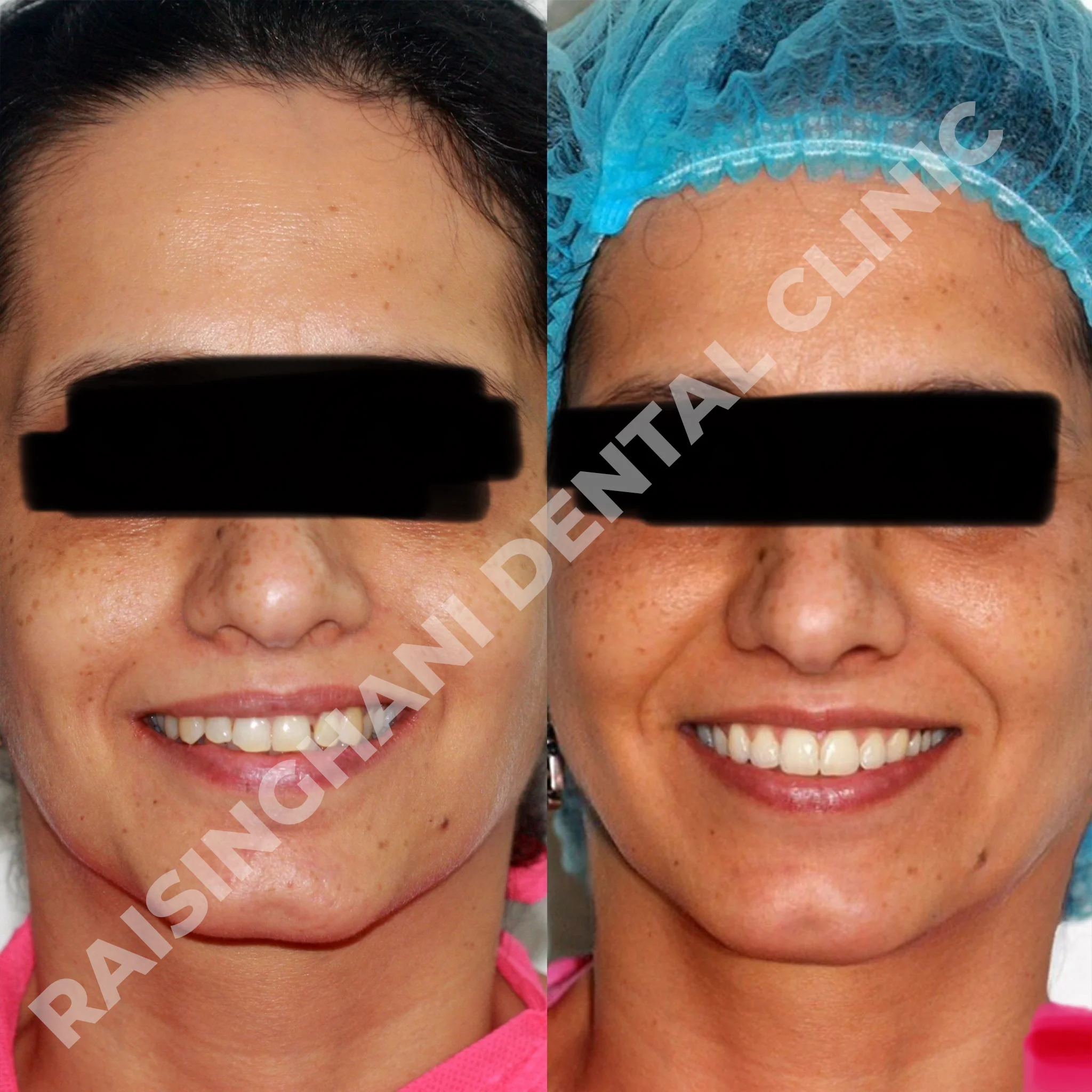 Braces & Aligners