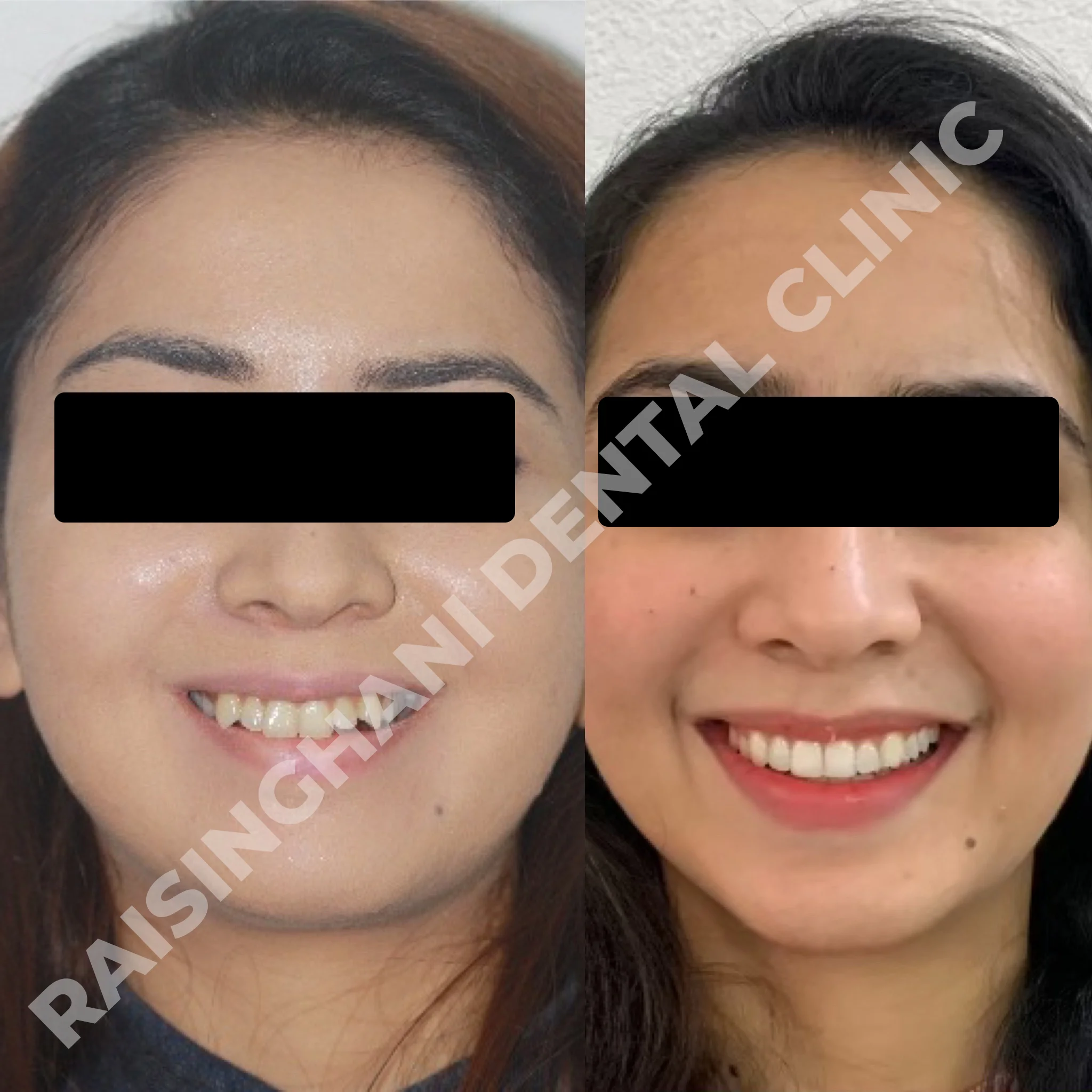Braces & Aligners