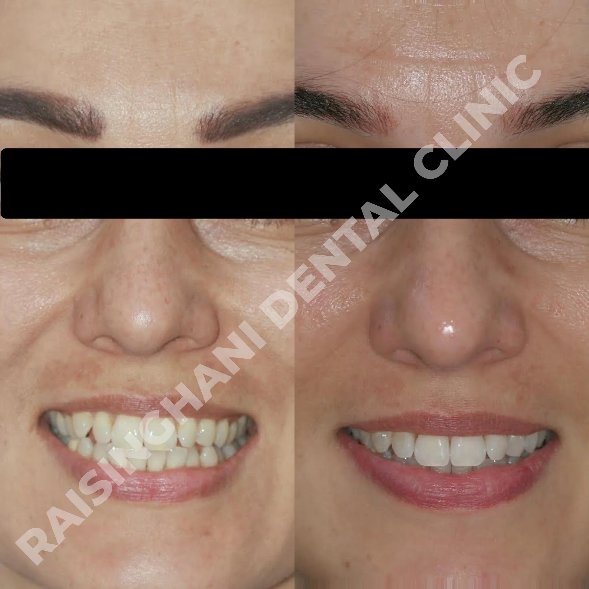 Braces & Aligners
