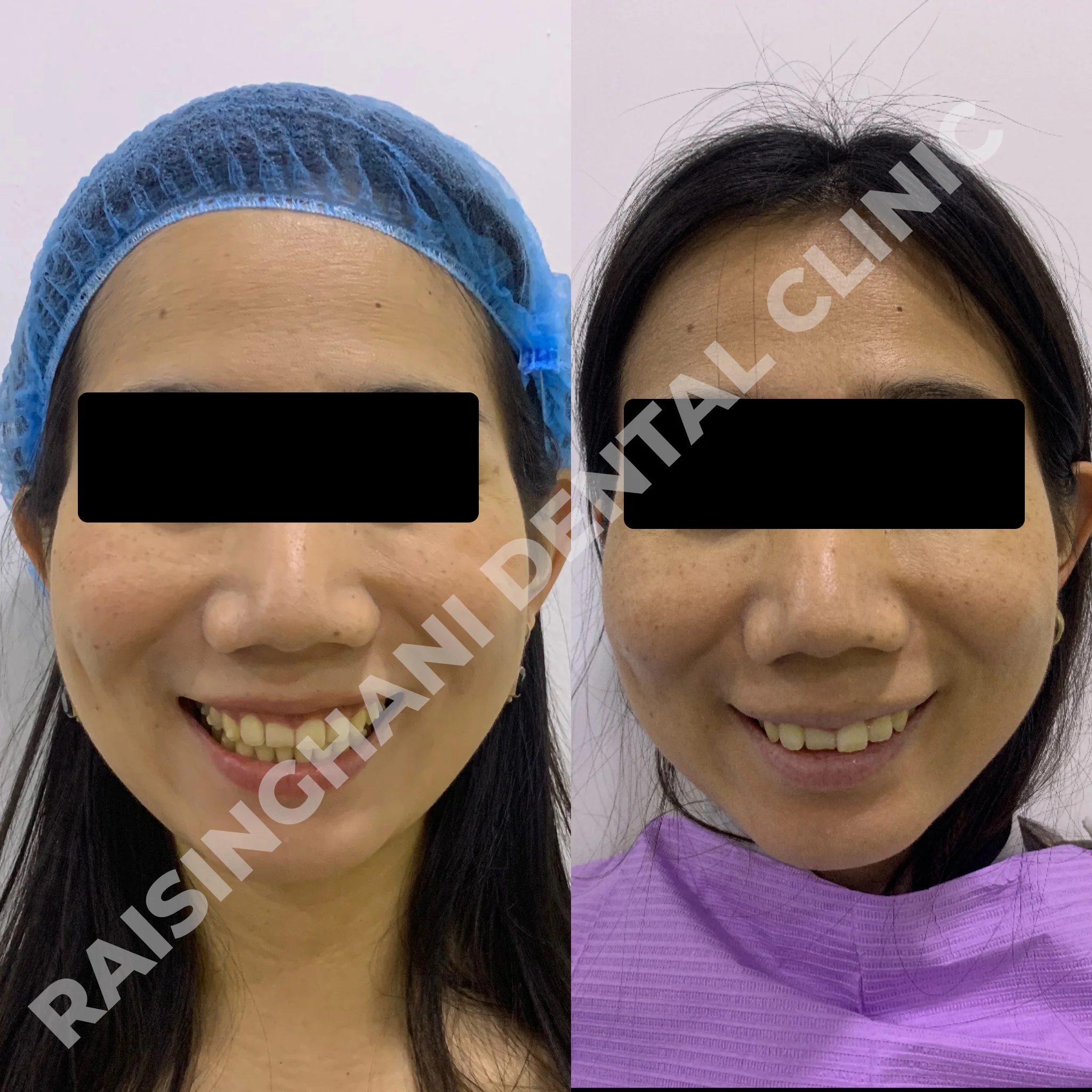 Braces & Aligners