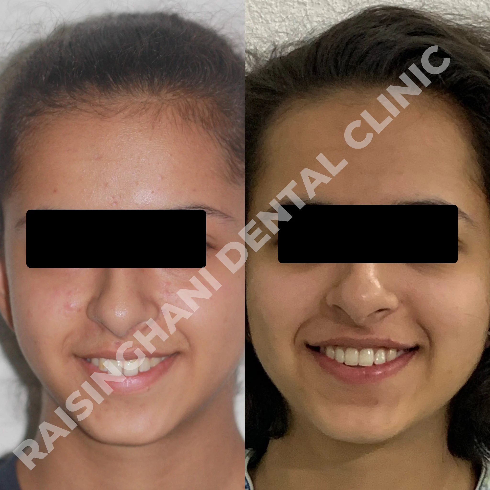Braces & Aligners