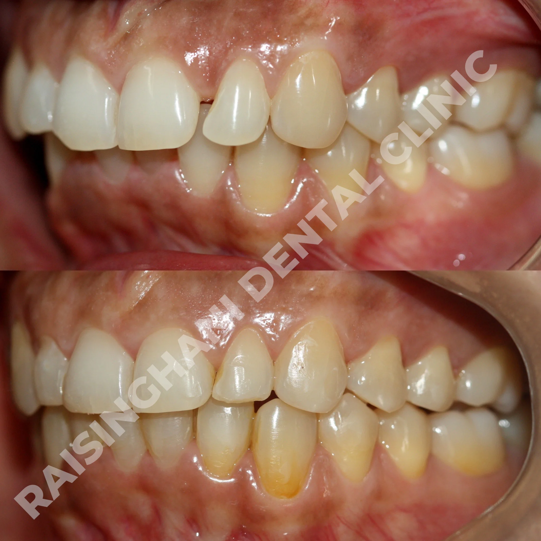 Braces & Aligners