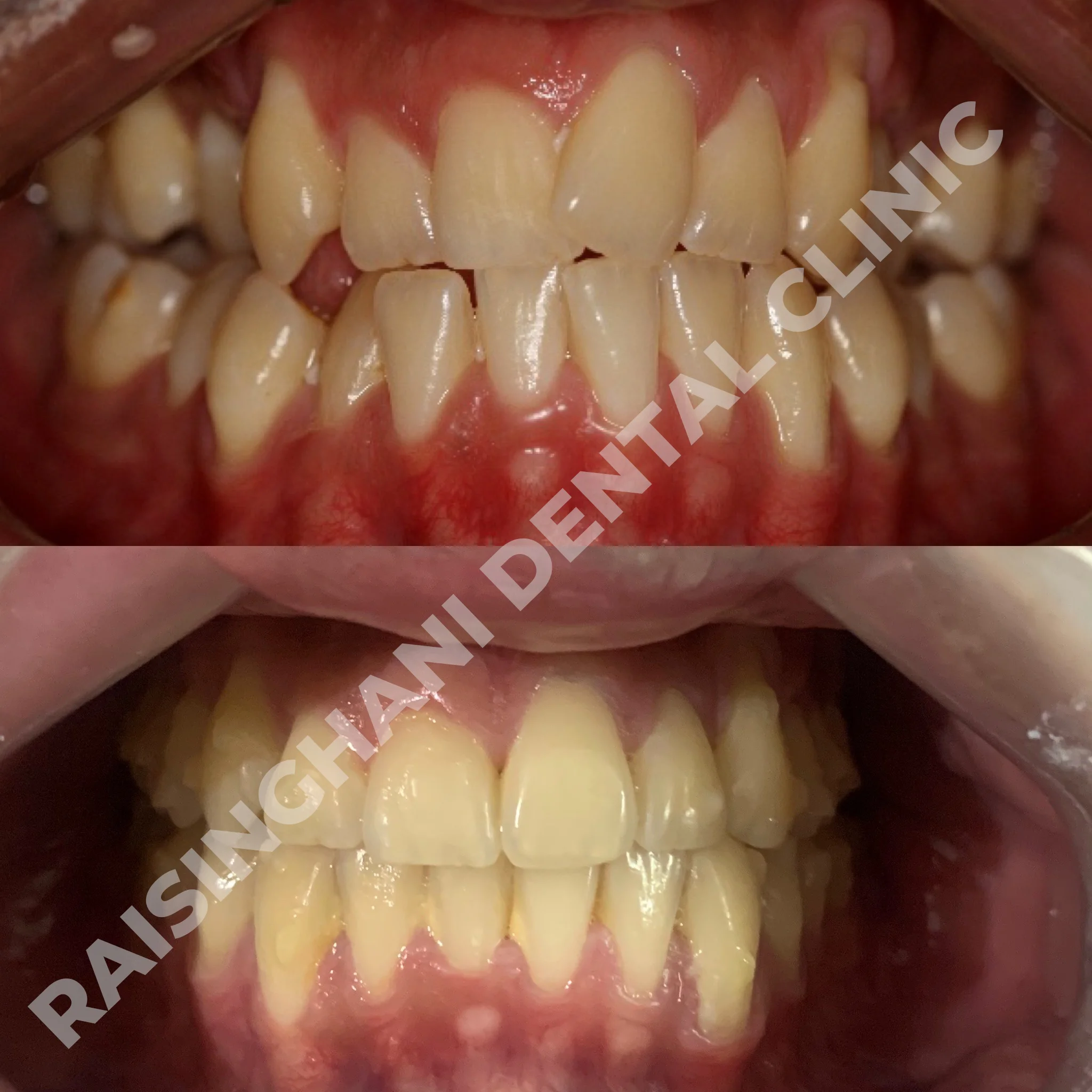 Braces & Aligners