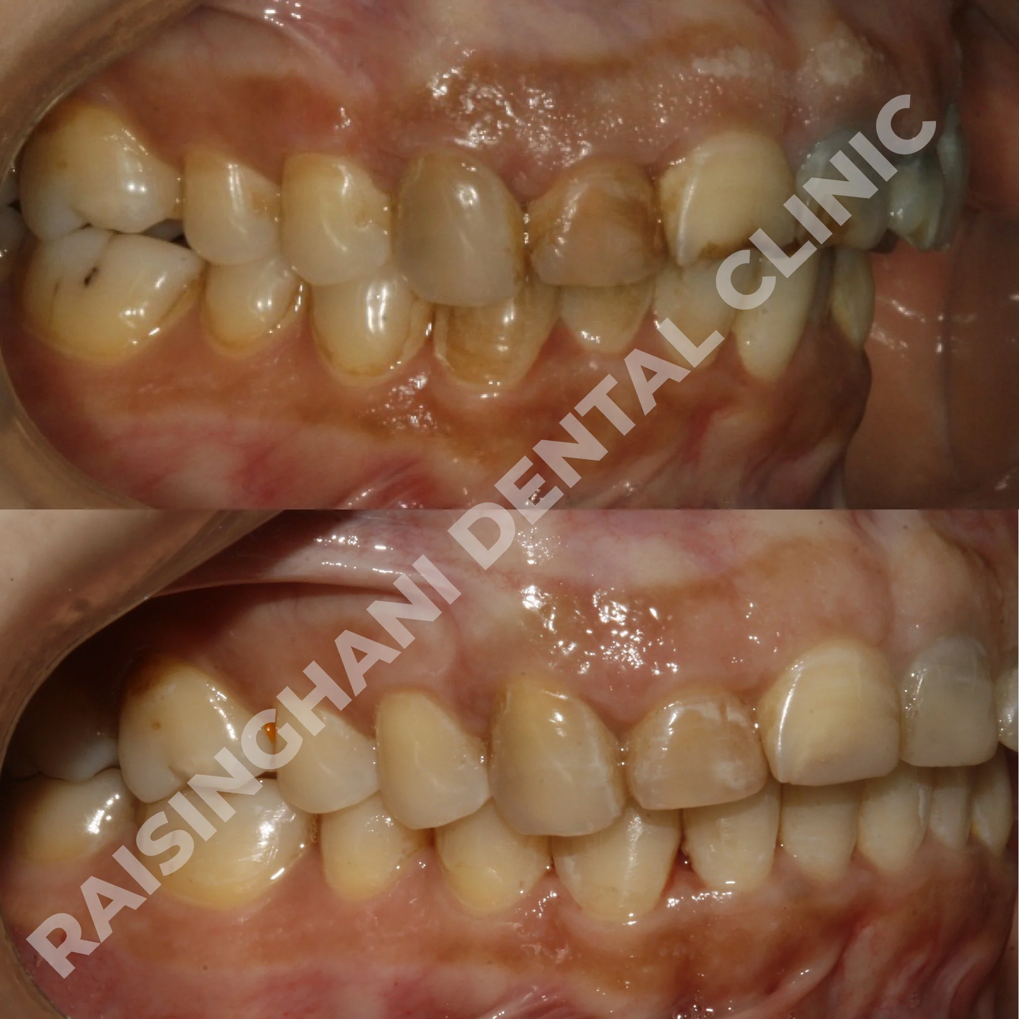 Braces & Aligners