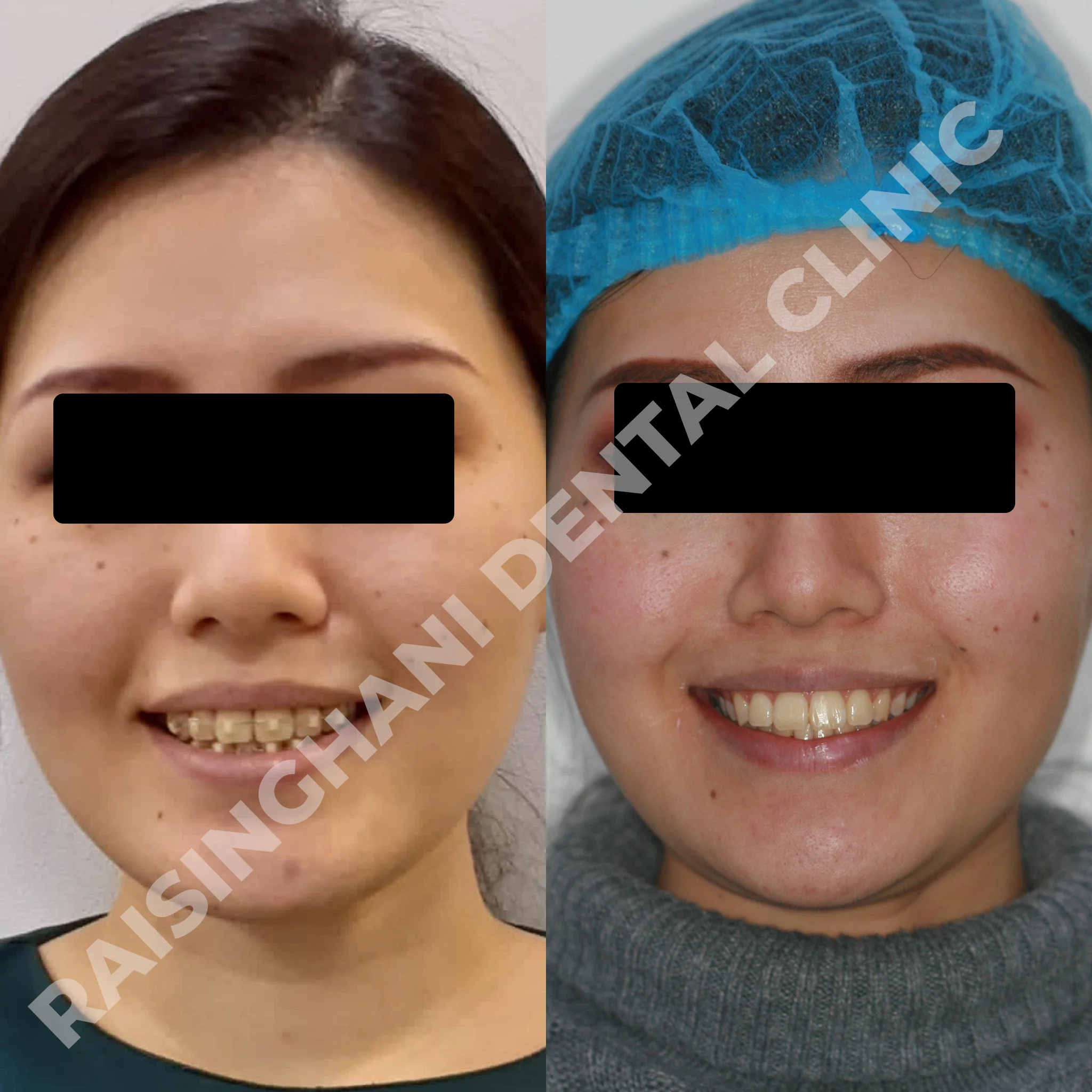 Braces & Aligners
