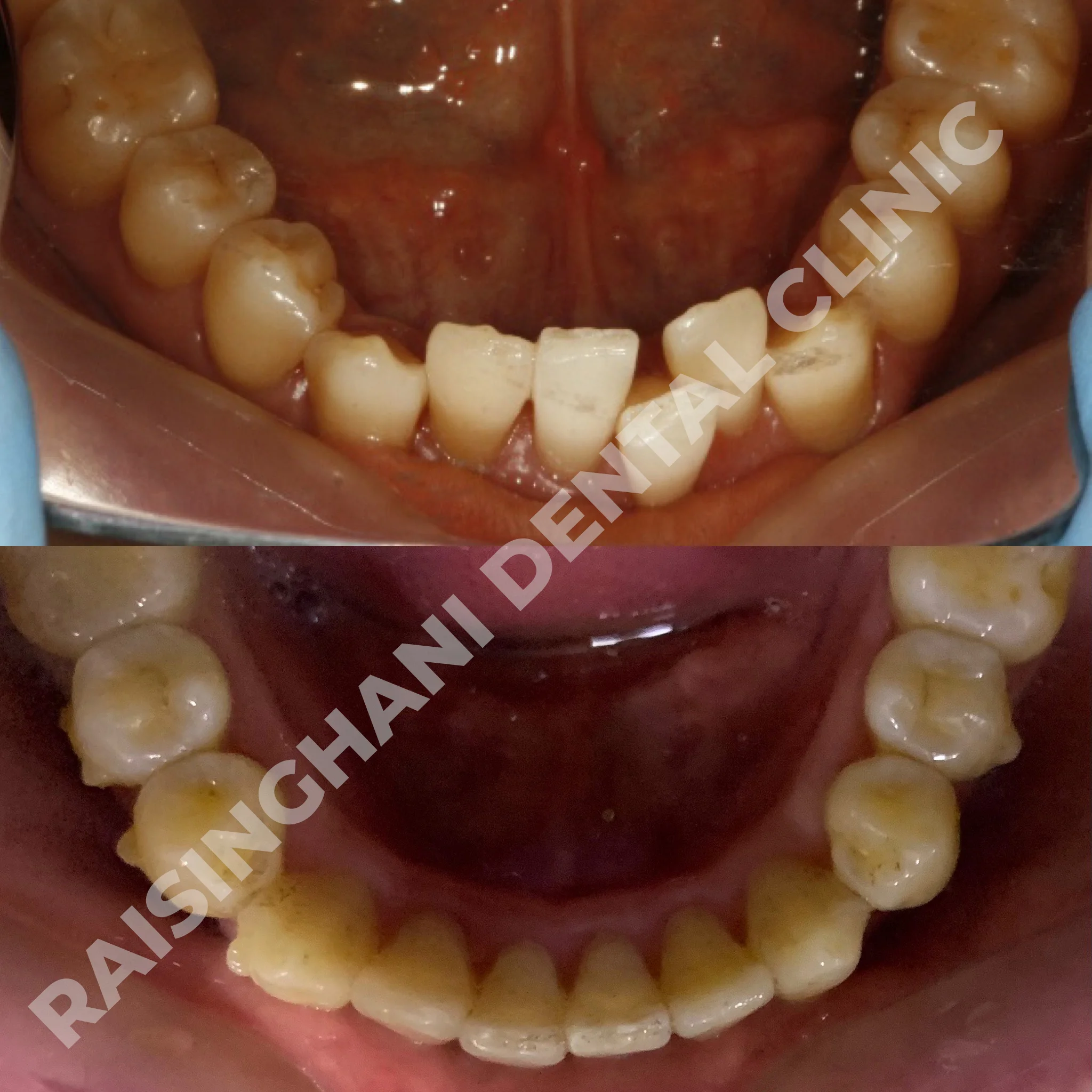 Braces & Aligners