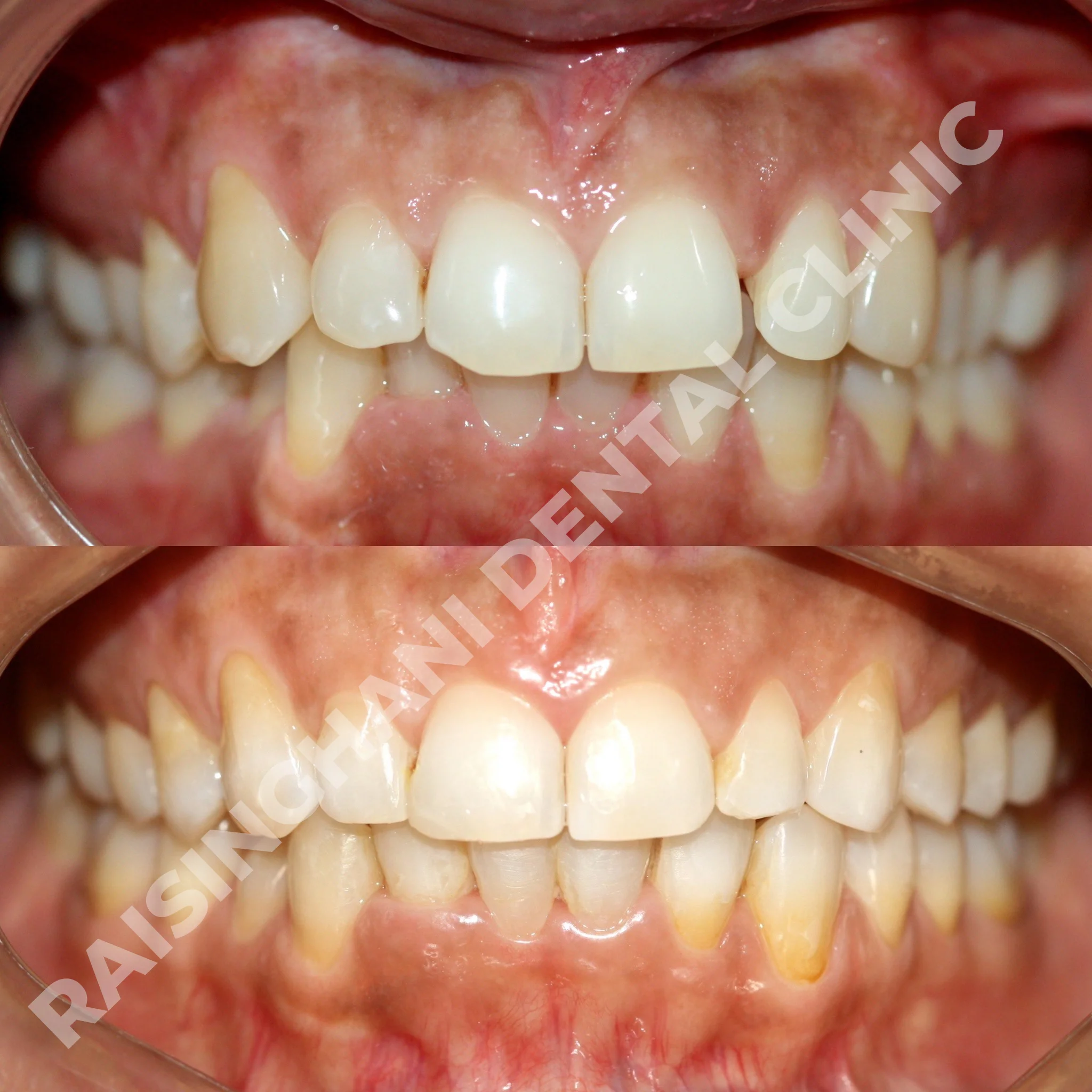 Braces & Aligners