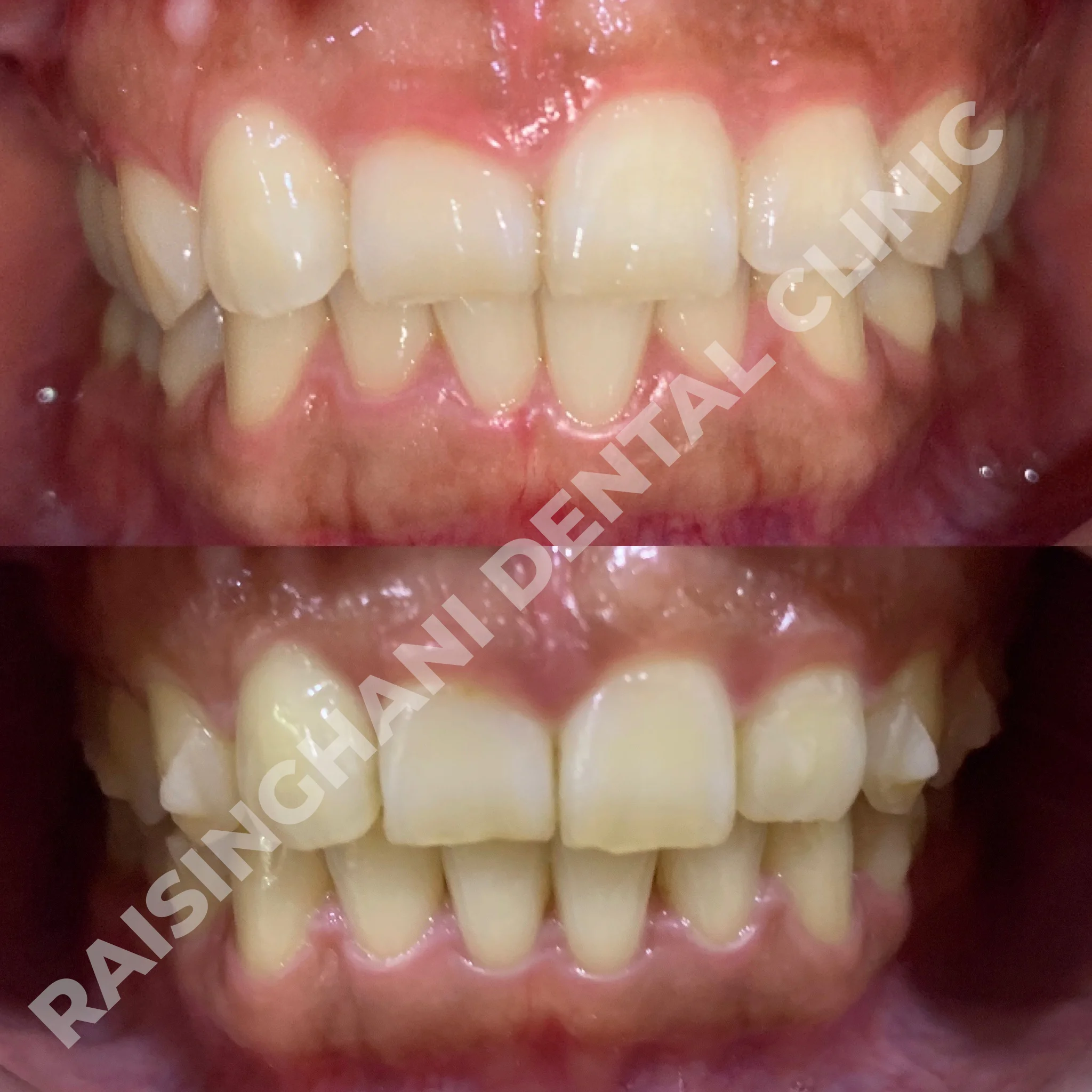 Braces & Aligners