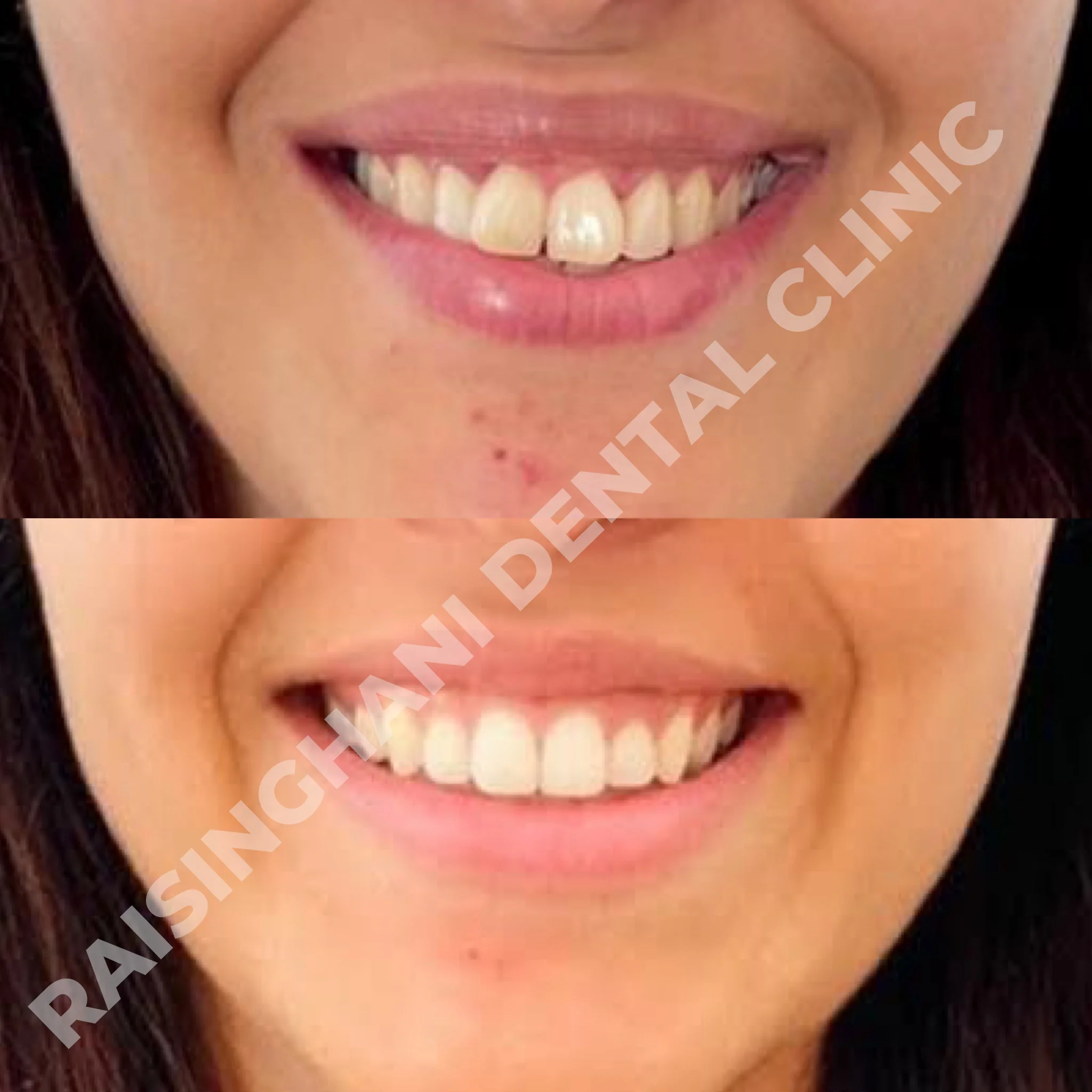 Braces & Aligners