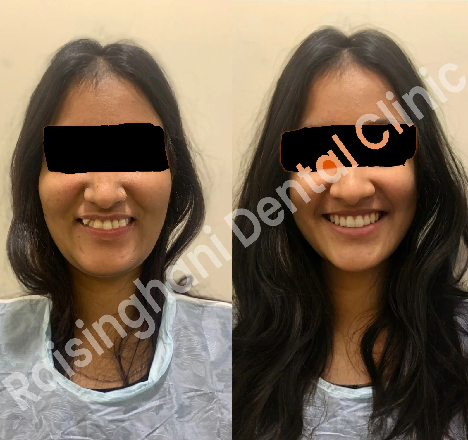 Braces & Aligners