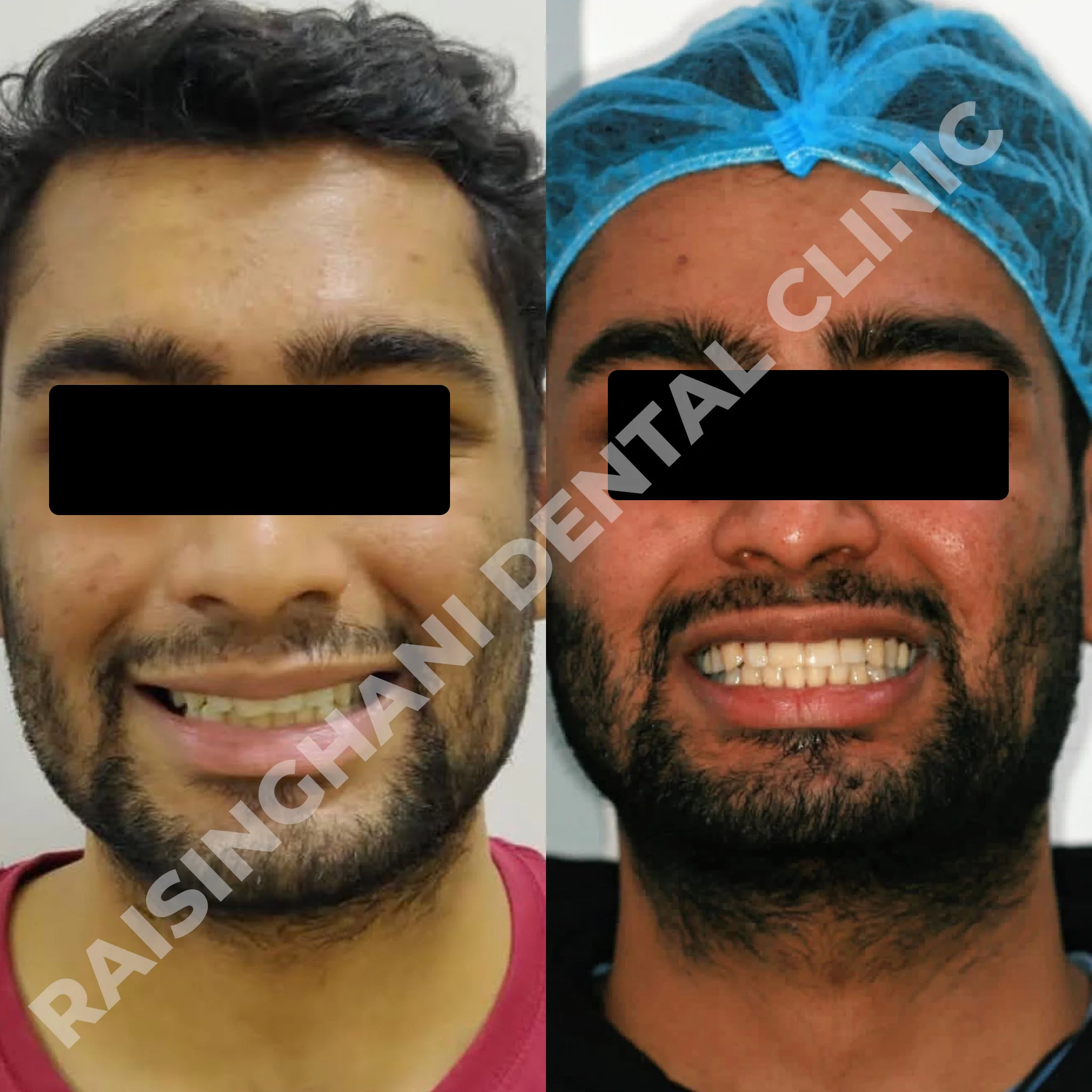 Braces & Aligners