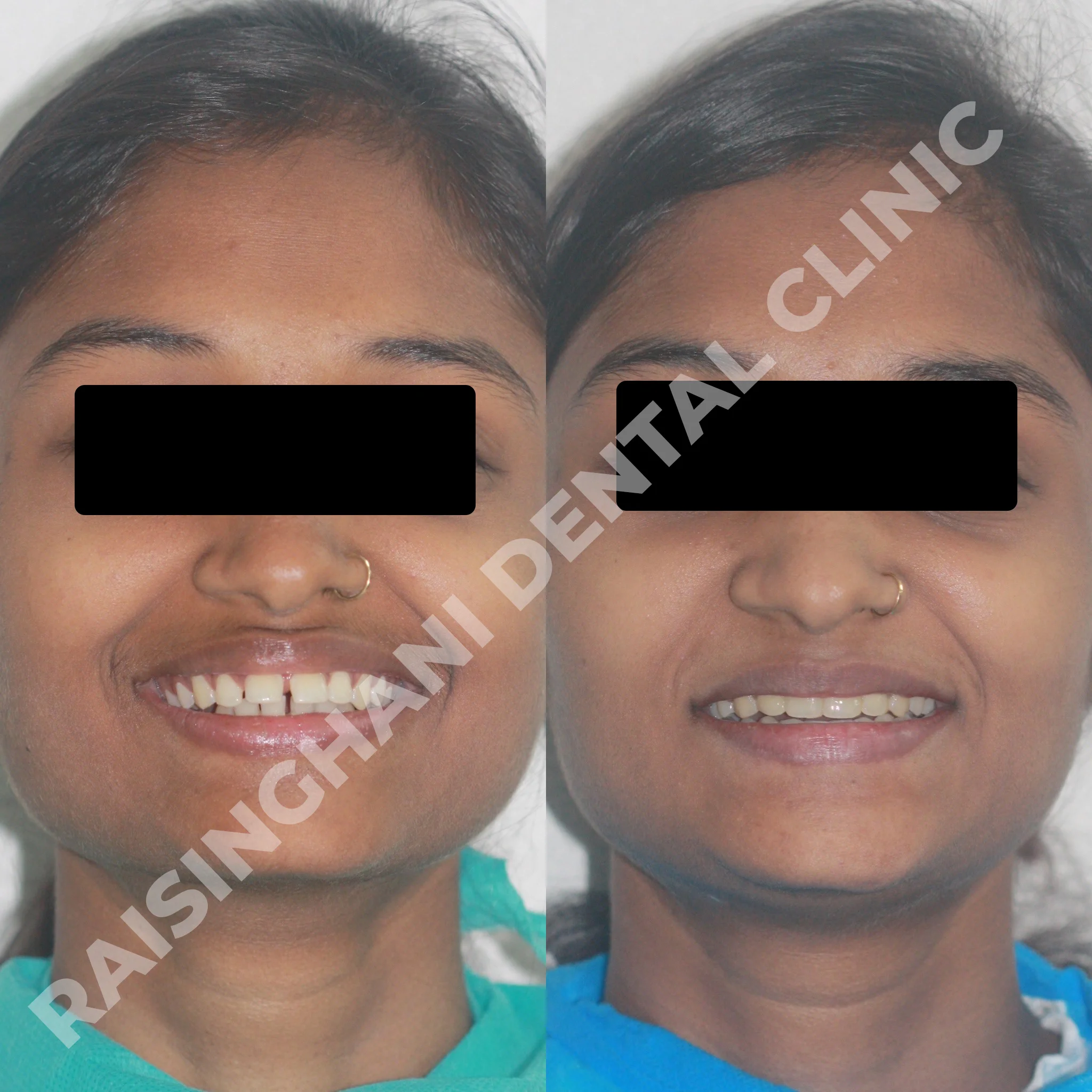 Braces & Aligners