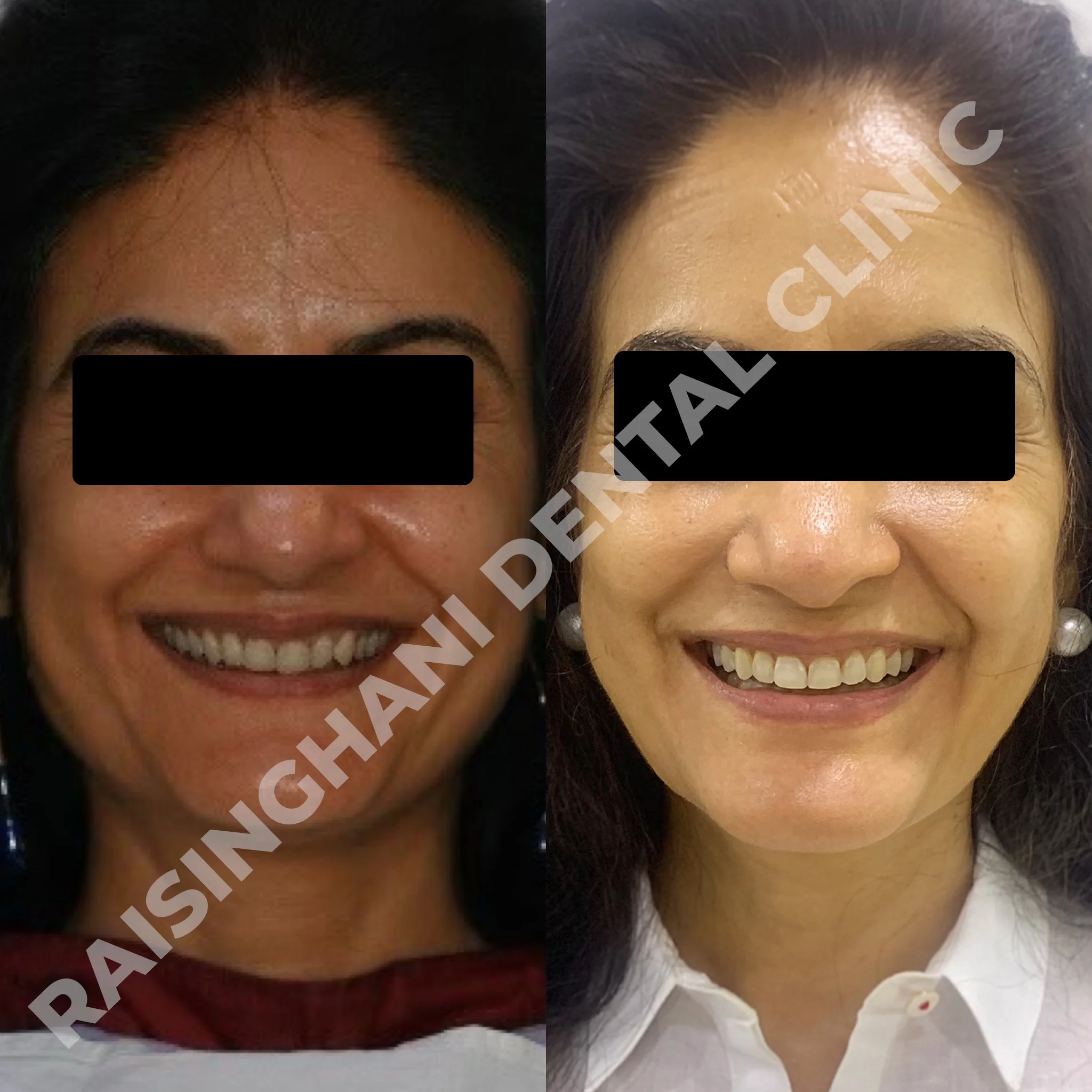 Braces & Aligners