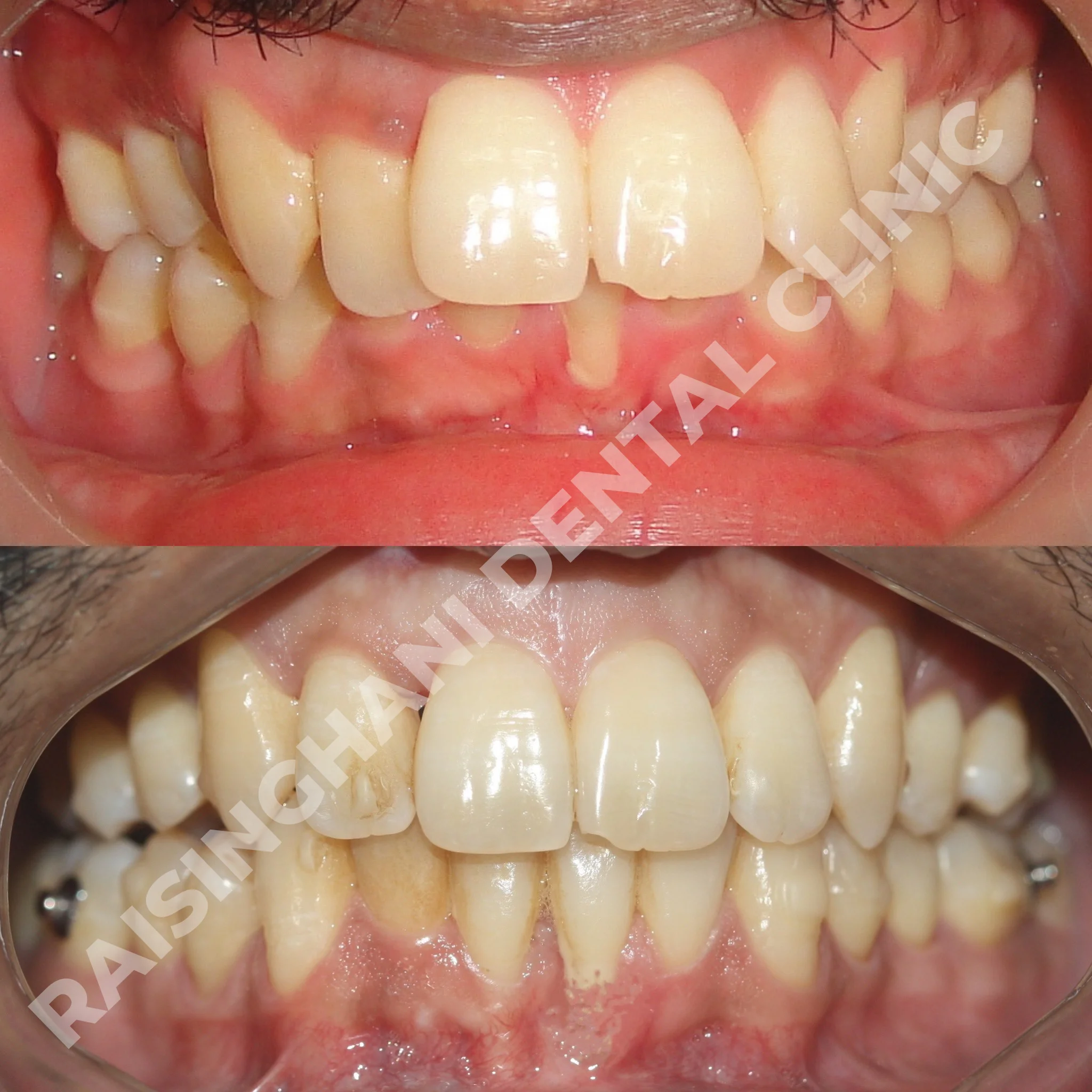 Braces & Aligners
