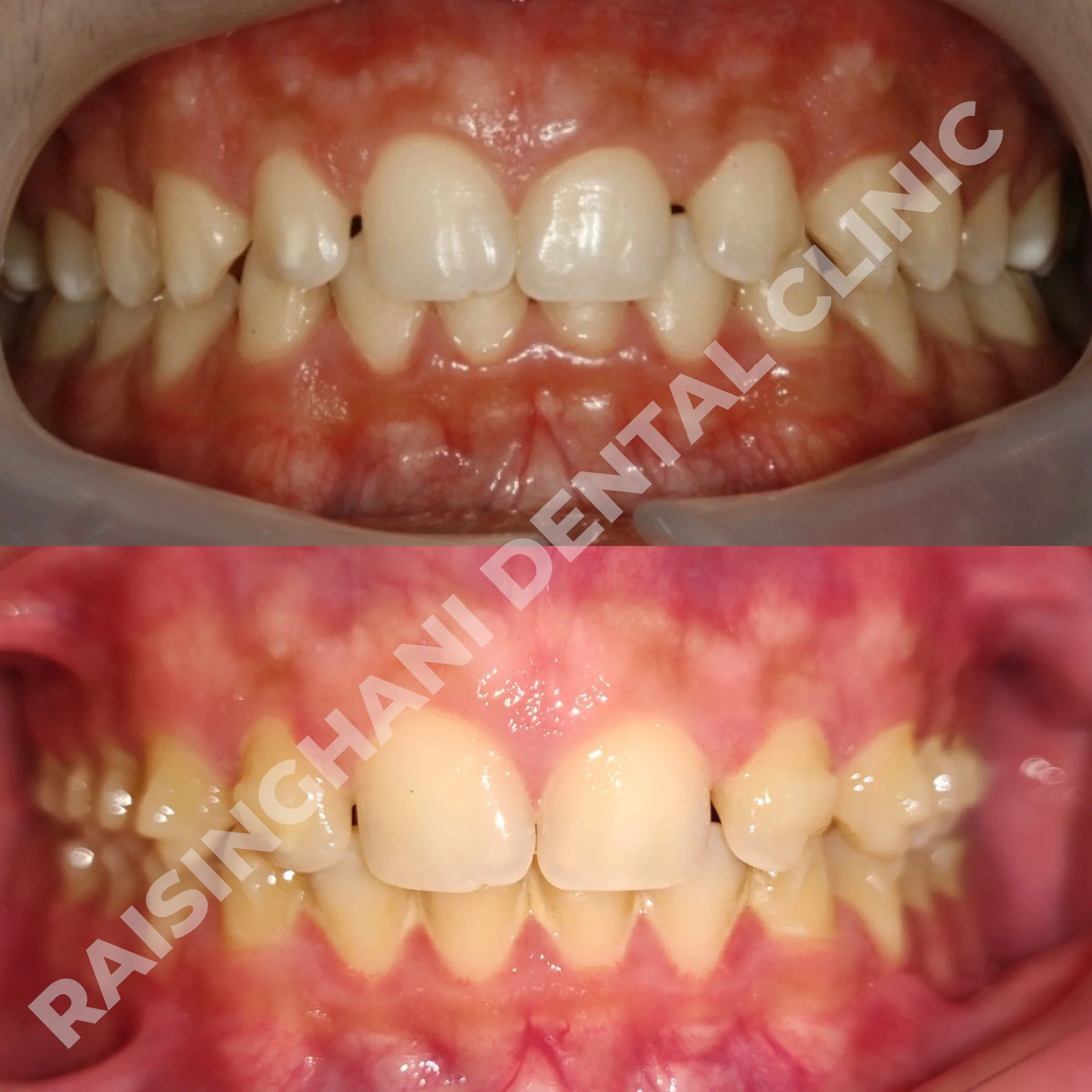 Braces & Aligners