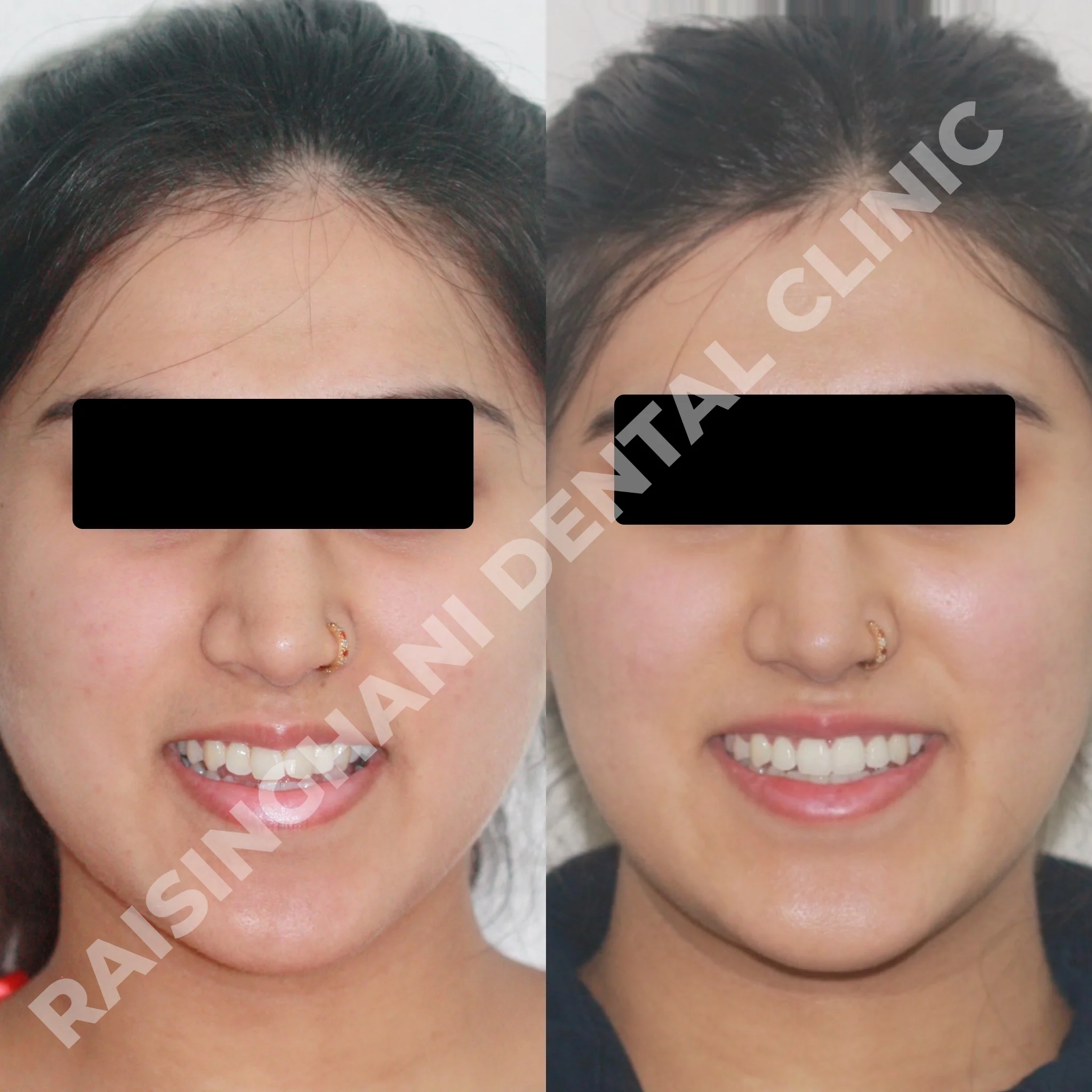 Braces & Aligners
