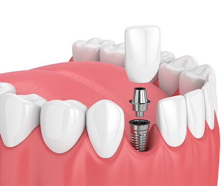 Dental Implant