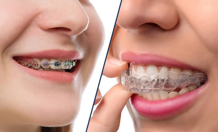 Braces / Aligner Treatment