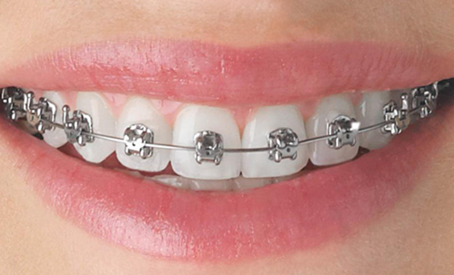 Braces Treatment