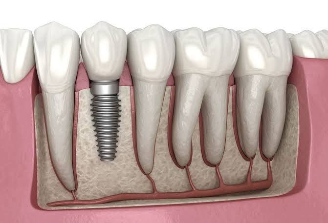 Implant Dentistry